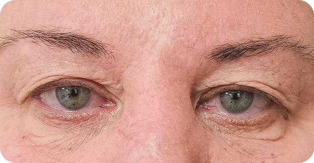 Before treatment