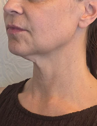 Before treatment