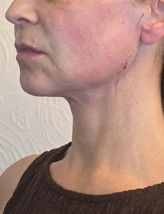 After treatment