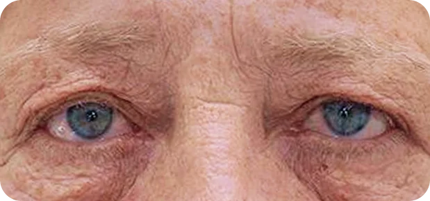 Before treatment