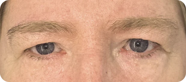 Before treatment