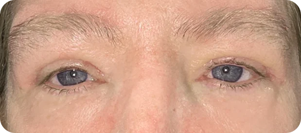 After treatment