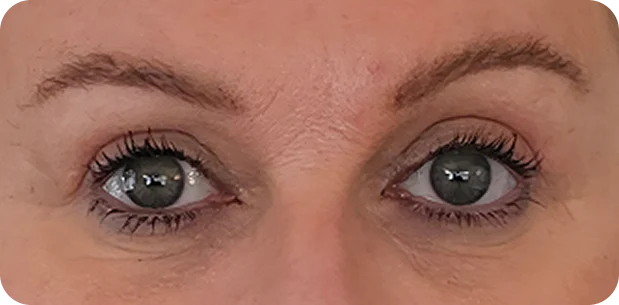 After treatment
