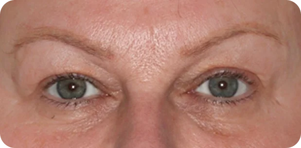 Before treatment