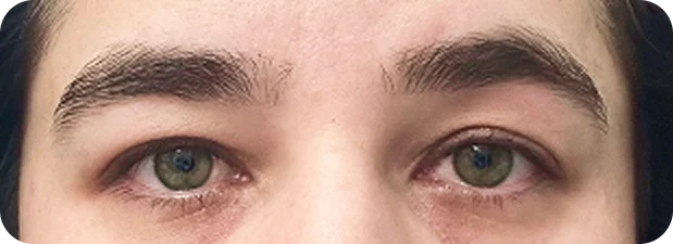 Before treatment
