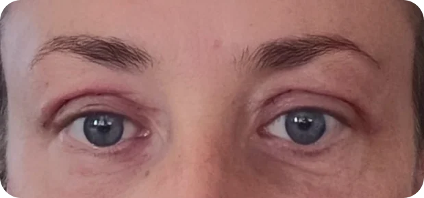 After treatment