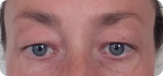 Before treatment