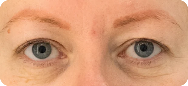 Before treatment