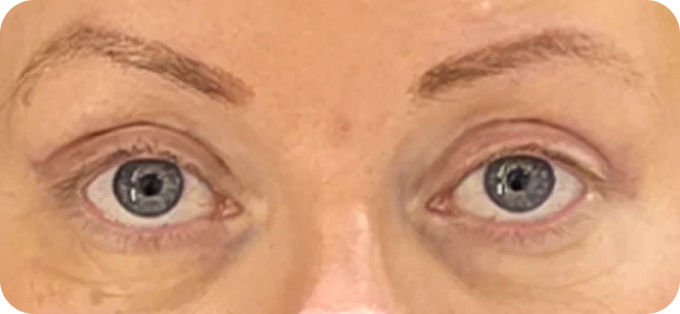 After treatment