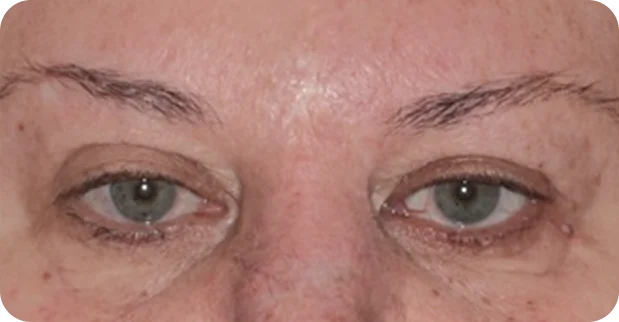 After treatment